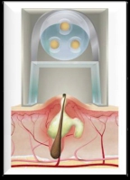 Acleara Mechanism, How Acne Treatments Works