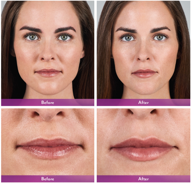 Volbella XC before and after lips