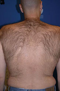 Laser Hair Removal Back Before, hair removal videos, hair removal pictures, photos, laser hair removal testimonials, Gold Standard, Before, after, laser treatment, FDA approved, Pittsburgh, underarms, back, chest, legs, neck, face, arms, Brazilian, nose hair, toe hair, Youtube video playlist, Cosmetic injections pittsburgh, BOTOX® Cosmetic pittsburgh, wrinkles pittsburgh, laser pittsburgh, spider veins pittsburgh, EVLT, Endovenous laser treatments, varicose veins, varicose vein treatments, endo venous laser, acne pittsburgh, acne light pittsburgh, levulan pittsburgh, erbium laser pittsburgh, Dermal Remodeling Laser pittsburgh, restylane, laser peel, skin resurfacing, rejuvenation, Collegen, Plastic, Cosmetic, Surgeon, zeno, hairmax, lasercomb, laser comb, hair loss, hair restoration, Prevage, prevage pittsburgh, prevage antioxidant, idebenone, idebenone antioxidant, allergan cream, allergan antioxidantlaser, laser skin care, laser resurfacing, laser vein treatments, Pittsburgh, Pennsylvania, Pgh, Plastic, Surgery, PA, WV, NY, OH