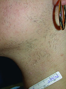 laser hare reduction before, hair removal videos, hair removal pictures, photos, laser hair removal testimonials, Gold Standard, Before, after, laser treatment, FDA approved, Pittsburgh, underarms, back, chest, legs, neck, face, arms, Brazilian, nose hair, toe hair, Youtube video playlist, Cosmetic injections pittsburgh, BOTOX® Cosmetic pittsburgh, wrinkles pittsburgh, laser pittsburgh, spider veins pittsburgh, EVLT, Endovenous laser treatments, varicose veins, varicose vein treatments, endo venous laser, acne pittsburgh, acne light pittsburgh, levulan pittsburgh, erbium laser pittsburgh, Dermal Remodeling Laser pittsburgh, restylane, laser peel, skin resurfacing, rejuvenation, Collegen, Plastic, Cosmetic, Surgeon, zeno, hairmax, lasercomb, laser comb, hair loss, hair restoration, Prevage, prevage pittsburgh, prevage antioxidant, idebenone, idebenone antioxidant, allergan cream, allergan antioxidantlaser, laser skin care, laser resurfacing, laser vein treatments, Pittsburgh, Pennsylvania, Pgh, Plastic, Surgery, PA, WV, NY, OH