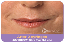 Juvederm before and after, Commonly Treated Areas, Juvedurm, Cosmetic Benefits of Injectable Gel Filler, Collagen, stressed appearance, method, reduce signs of aging, wrinkles, benefits of injectable gels, smoother, more youthful-looking skin, facial lines, Fillers treat, Fillers have, appearance of prominent, deep Wrinkle Lines , Facial Expression Lines, Facial wrinkles , Fine lines, Lip Augmentation, Juvederm, Perlane, Restylane, Lip line definition, Plumping Thin Lips, Improving 'lipstick lines, vertical lines , upper lip, lipstick, Frown lines, nose, nostrils, Brows , Glabella, procerus, corrugator muscles, 1’s, 11’s, 111’s, Temples, Smile Lines, Laugh lines, Nasolabial folds, Sculptra, Prejowl Sulcus, Cheek hollowing,