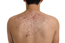 Skin Tag Important Information, Acne and scars (keloids). Dermatology, skin disease.