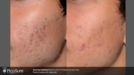 Before and after PicoSure Acne scarring
