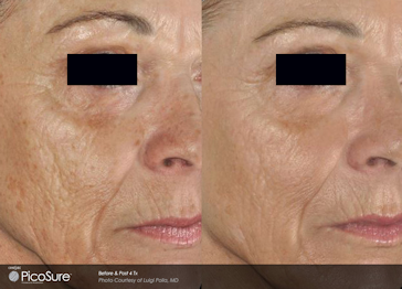 Before and after Picosure Wrinkle