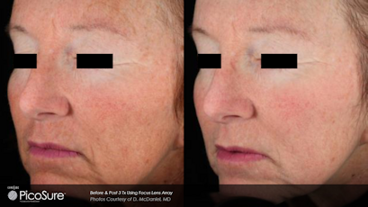Before and after Picosure Wrinkle