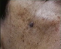 Skin Tags important information, Fibromas, Telangiectasia, small spider vein, Molluscum Contagiosum, Pyogenic Granuloma, Melanocytic