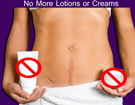 No More Lotions or creams remove scar and stretch marks with laser