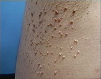 Skin Tags important information common skin growth,. Skin tags, Warts, Skin Tags, Cherry Angiomas, Telangiectasia, small spider vein, Molluscum Contagiosum, Pyogenic Granuloma, Melanocytic Nevus, Benign Tumors, Multiple Skin Abnormalities or Blemishes, Hyfrecator, Warts and Moles