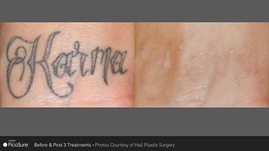 before and after tattoo removal PicoSure, Q-Switch, R20 and 1540