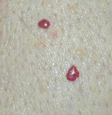 Types of birthmarks Cherry Angioma