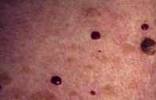 Types of birthmarks Cherry Hemangioma
