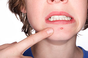Photofacial Treatment Options for acne Pimple, Cosmetic Vascular, Sun, Age, Brown and Red Spots, Active Acne Blemishes,