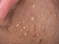 Skin Tag Important Information, milias and clogged pores Milia A firm cyst filled with keratin