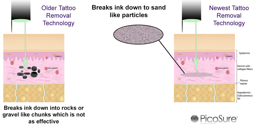 Updated Tattoo removal tech technology diagram, free consultation, best technology, unwanted tattoo, regret, Important Tattoo Facts, professional, experienced, internationally trained, certified laser technicians, educated, unsightly tattoo, best results, cover up, Total Removal,