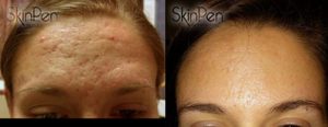 skin pen before and after, skin pen, micro needles, derma pen, dermal rollers, punctured holes, hera microneedle machine, needles, poke holes, wrinkles, fine lines, collagen, smooth texture, scars, divots, skin tone, Hyaluronic Acid, fast, stimulate collagen, eliminate scars, crow’s feet, upper lip wrinkles, fraxel laser, skin tightening, minimally invasive, minimal downtime, safe, price