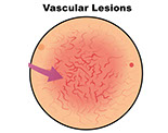 Types of birthmarks Vascular Malformations