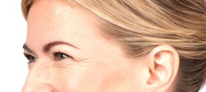 Botox crows feet, BOTOX Cosmetic, BOTOX®, botox Pittsburgh, botox treatment, botox procedures, botox injection, Cosmetic injections, wrinkles, eye, brow, brows, injections, botulinum, Anti perspire, sweating, chronic migranes, relax muscles, furrows, crow's feet, voluptuous lips, thinning lips, botox cost, botox prices, botox photo, botox pictures, Cosmetic, Surgeon,