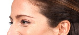 Botox crows feet, BOTOX Cosmetic, BOTOX®, botox Pittsburgh, botox treatment, botox procedures, botox injection, Cosmetic injections, wrinkles, eye, brow, brows, injections, botulinum, Anti perspire, sweating, chronic migranes, relax muscles, furrows, crow's feet, voluptuous lips, thinning lips, botox cost, botox prices, botox photo, botox pictures, Cosmetic, Surgeon,