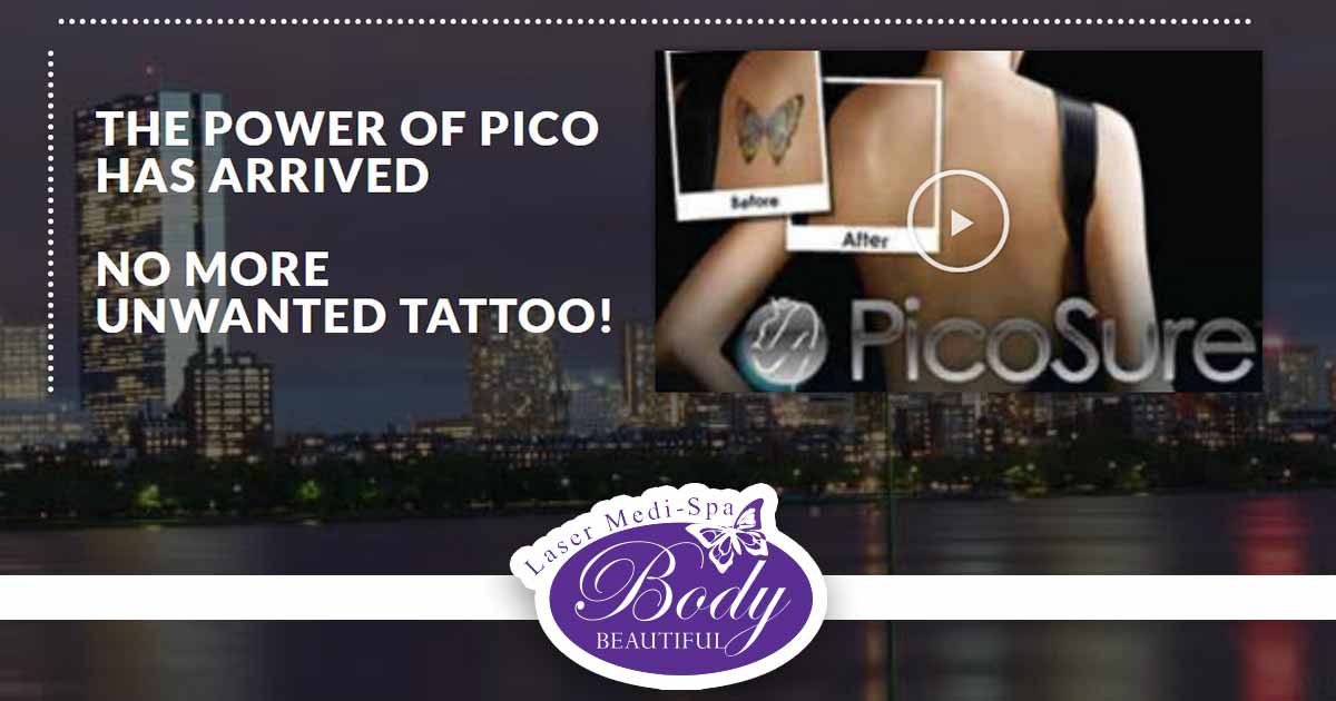 Remove Unwanted Tattoo