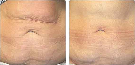 Body Contouring Before and After, laser lipo, lipo dissolve, electrothermal, thermigen, thermage, thermotherapy, body lift, accent, ultra accent, ultra xl, body slimming, tone, tighten, ultrashape, endermologie, velasmooth, lipomassage, bella contour, liptron 3000, mesotherapy, laser lipolysis, smart lipo, non invasive fat reduction, cool sculpting, laser body sculpting, non surgical liposuction, laser fat removal, fraxel,