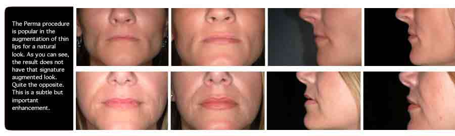 Augmented lips Before and after, Lip Augmentation Implants Perma