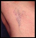sclerotherapy, trending treatments, near me, PIttsburgh Pa, Wexford Pa, Cranberry TWP PA
