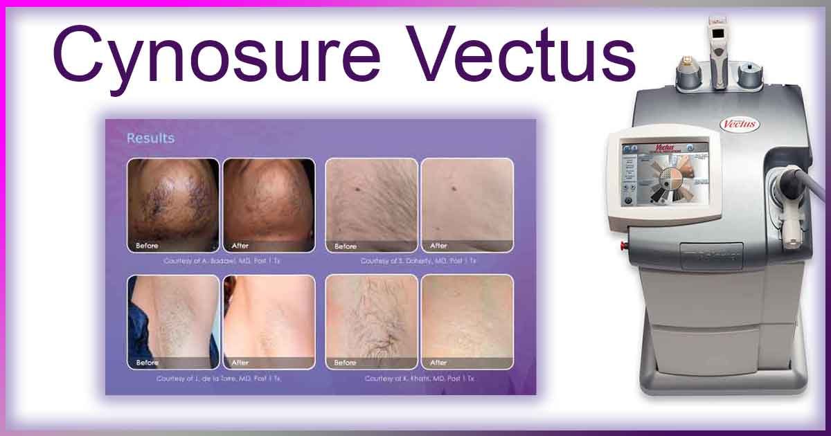 Cynosure Vectus