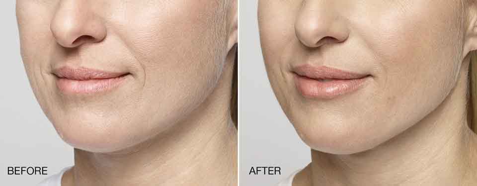 Restylane Silk, Restylane Price Pittsburgh Pa, Natural looking Filler Pittsburgh Pa, Cosmetic injections for Wrinkles, Restylane Galderma Fillers in Pittsburgh Pa,Correct facial wrinkles and nasolabial folds, Top Pittsburgh Pa Injector, Pittsburgh best Juvederm injector near me, 5 star cosmetic injectors,