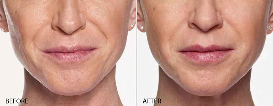 Restylane Silk, Restylane Price Pittsburgh Pa, Natural looking Filler Pittsburgh Pa, Cosmetic injections for Wrinkles, Restylane Galderma Fillers in Pittsburgh Pa,Correct facial wrinkles and nasolabial folds, Top Pittsburgh Pa Injector, Pittsburgh best Juvederm injector near me, 5 star cosmetic injectors,