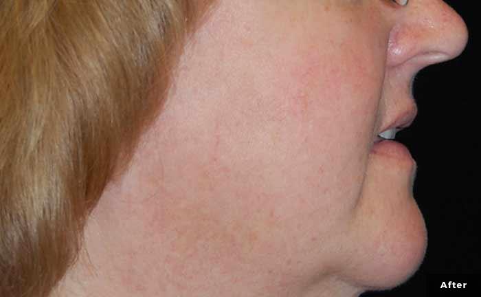 Before and afters, Cutera Pearl Fractional XEO, skin rejuvenation, scar removal, acne, acne scars, body stretch mark removal, discoloration, aging, wrinkles, pore size, Dark Spots, sun damage, age spots, sun spots, Freckles, Enlarged Pores, skin resurfacing,laser,irregular skin texture, enlarged pores, skin wrinkles, Smooths out wrinkles,
