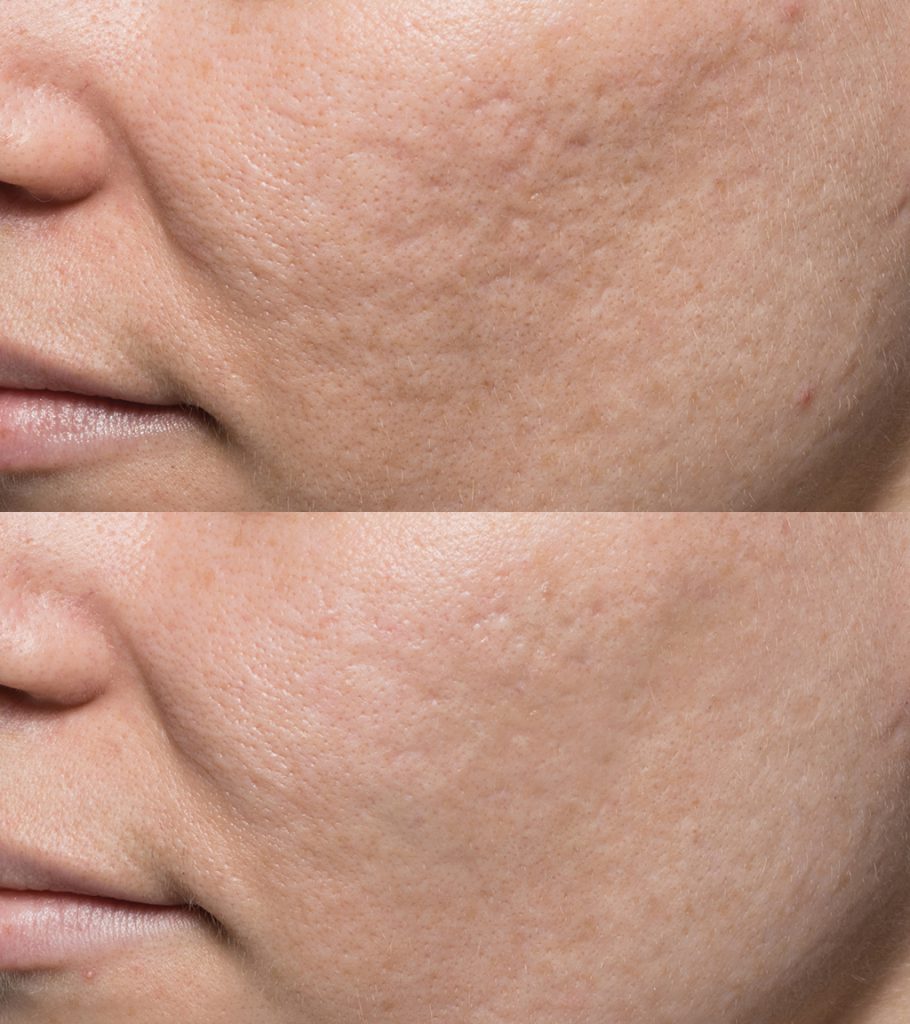 Bellafill filler results pittsburgh Pa Body Beautiful