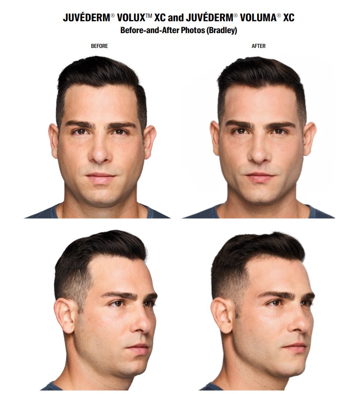 Juvederm Volux XC Before and Afters Mens Jawline