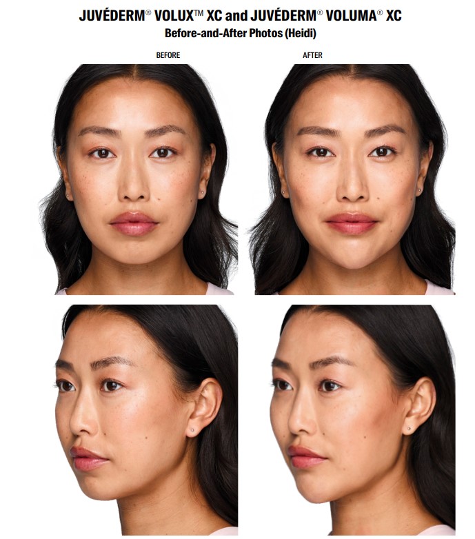 Juvederm Volux XC Before and Afters Womans Jawline