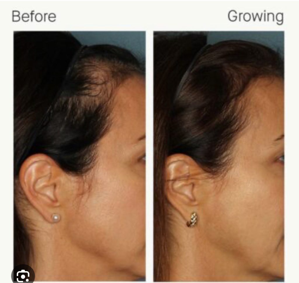 Nutrafol before and afters hair growth in Pittsburgh Pa