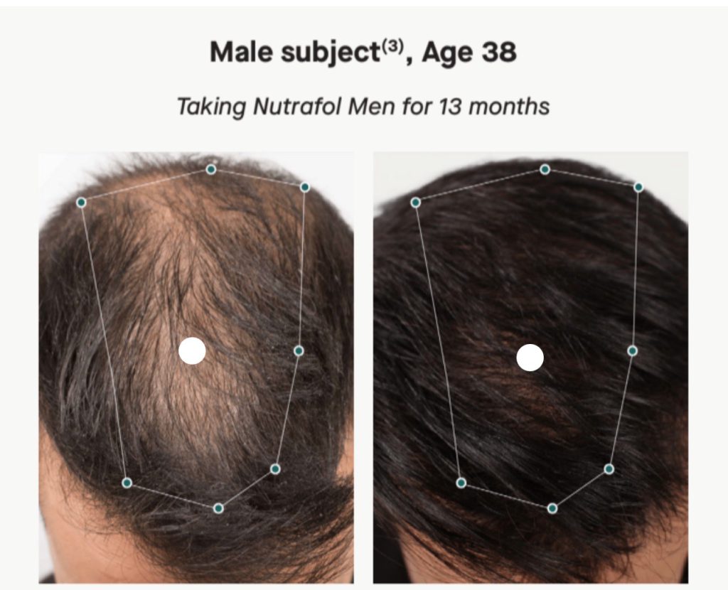 Nutrafol before and afters hair growth in Pittsburgh Pa