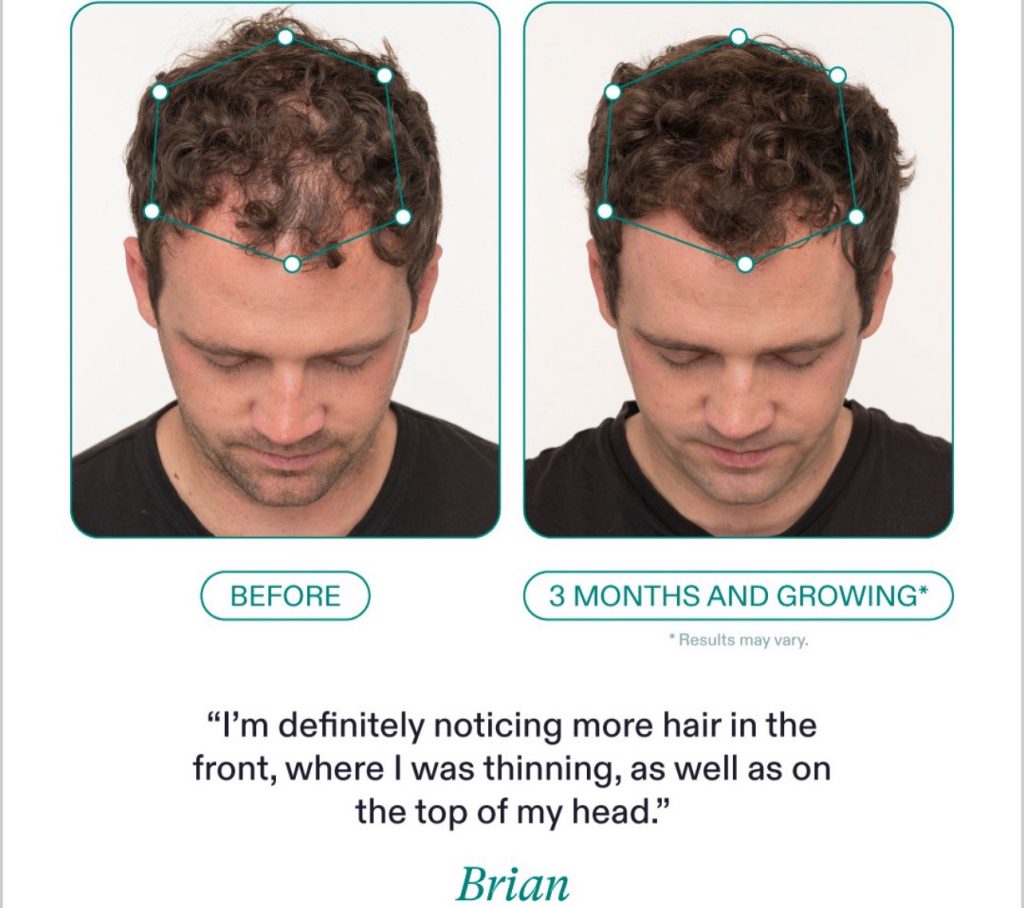 Nutrafol before and afters hair growth in Pittsburgh Pa