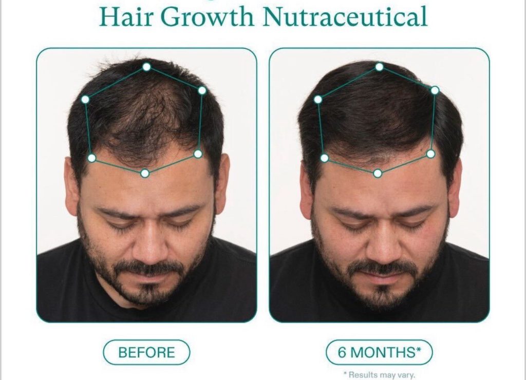 Nutrafol before and afters hair growth in Pittsburgh Pa